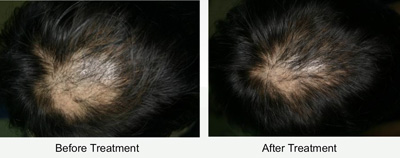 毛母細胞の活性化及び毛周期・血流の促進